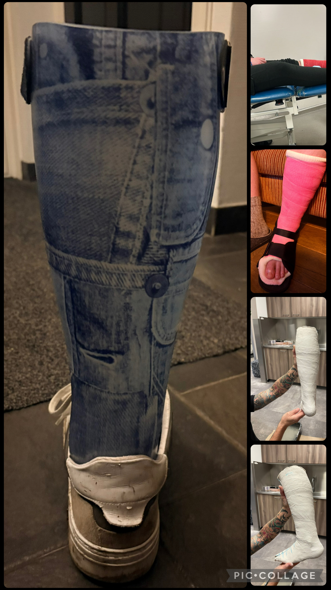 Scoliose, verkorte kuitpsier, gips en een spalk